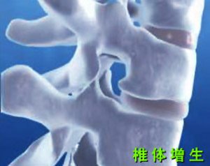 腰椎骨质增生症状.jpg 腰椎骨质增生症状.jpg