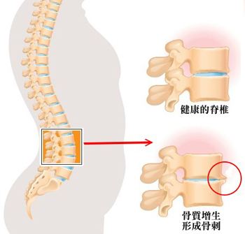 腰椎骨质增生的症状.jpg 腰椎骨质增生的症状.jpg