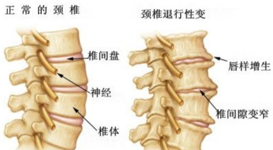 常见的腰椎骨质增生的症状.jpg 常见的腰椎骨质增生的症状.jpg
