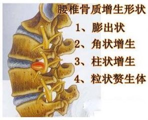 腰椎骨质增生.jpg 腰椎骨质增生.jpg