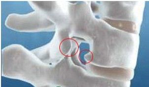 腰椎骨质增生产生的危害.jpg 腰椎骨质增生产生的危害.jpg