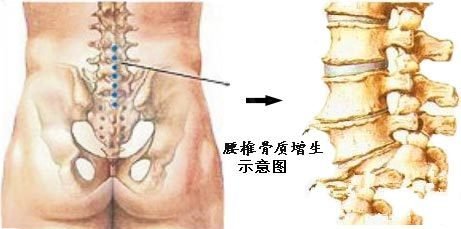 腰椎骨质增生预防理疗.jpg 腰椎骨质增生预防理疗.jpg