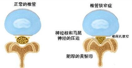 引起椎管狭窄的原因.jpg 引起椎管狭窄的原因.jpg