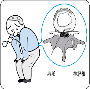 腰椎椎管狭窄.gif 腰椎椎管狭窄.gif