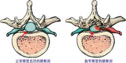 腰椎管狭窄的治疗方法.jpg 腰椎管狭窄的治疗方法.jpg