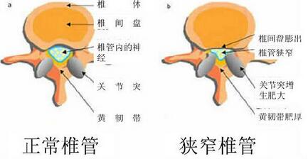 预防腰椎管狭窄.jpg 预防腰椎管狭窄.jpg