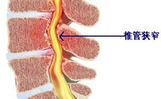 预防椎管狭窄.jpg 预防椎管狭窄.jpg