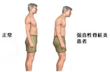 强直性脊柱炎病因.jpg