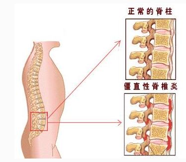 强直性脊柱炎的发病原因.jpg 强直性脊柱炎的发病原因.jpg
