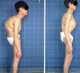 引起强直性脊柱炎的原因.jpg 引起强直性脊柱炎的原因.jpg