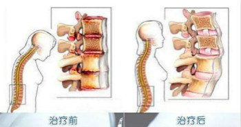 治疗强直性脊柱炎.jpg 治疗强直性脊柱炎.jpg