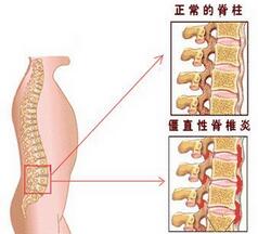 预防强直性脊柱炎.jpg