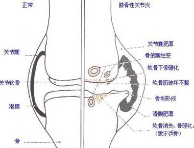 骨性关节炎发病.png 骨性关节炎发病.png
