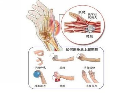 腱鞘炎wew.jpg 腱鞘炎wew.jpg