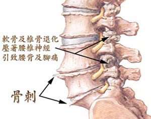 骨质增生症状.jpg 骨质增生症状.jpg