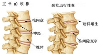 骨质增生常见的症状2.png 骨质增生常见的症状2.png