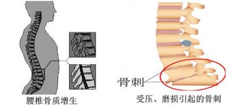 骨质增生治疗方法.jpg 骨质增生治疗方法.jpg