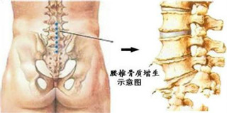 骨质增生的主要原因1.jpg 骨质增生的主要原因1.jpg
