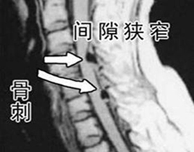 关节骨质增生治疗误区.jpg 关节骨质增生治疗误区.jpg