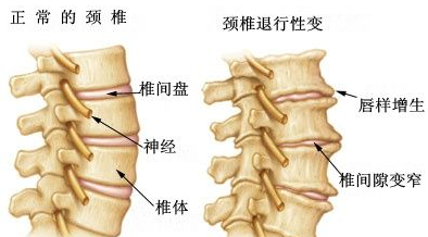 骨质增生常见的症状1.png 骨质增生常见的症状1.png