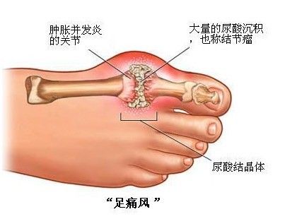 痛风.jpg 痛风.jpg