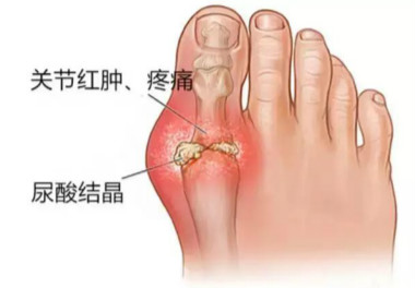 痛风的危害.jpg 痛风的危害.jpg