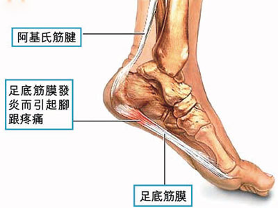 跟腱炎的临床症状.jpg 跟腱炎的临床症状.jpg