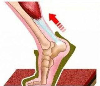 常见的跟腱炎症状.jpg 常见的跟腱炎症状.jpg