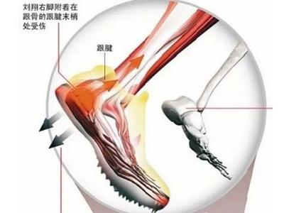 跟腱炎的临床症状表现.jpg 跟腱炎的临床症状表现.jpg