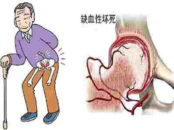 股骨头坏死3.jpg 股骨头坏死3.jpg