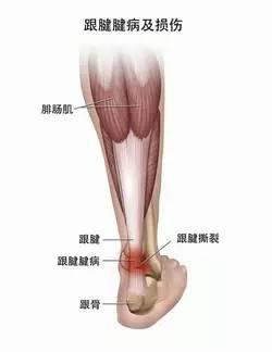 跟腱炎危害.jpeg 跟腱炎危害.jpeg