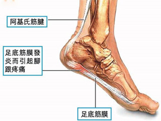 跟腱炎1.jpg 跟腱炎1.jpg