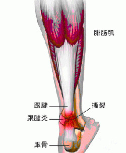 避免跟腱炎的困扰.jpg 避免跟腱炎的困扰.jpg