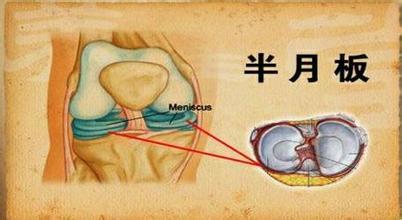 半月板损伤的病因.jpg 半月板损伤的病因.jpg