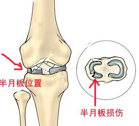 半月板损伤治疗.jpg 半月板损伤治疗.jpg