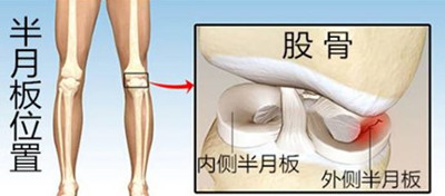 半月板.jpg 半月板.jpg