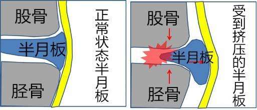半月板损伤原因.jpg 半月板损伤原因.jpg