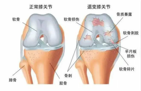 半月板损伤康复期间注意事项.jpg 半月板损伤康复期间注意事项.jpg