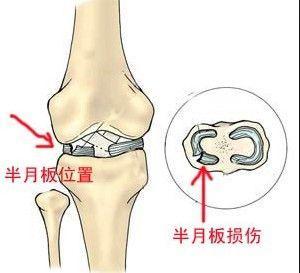 半月板损伤治疗1.jpg 半月板损伤治疗1.jpg