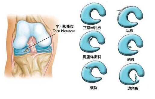 半月板撕裂的治疗.jpg 半月板撕裂的治疗.jpg