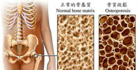 骨质疏松治疗.jpg 骨质疏松治疗.jpg