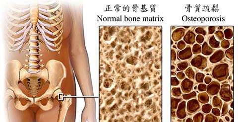 骨质疏松治疗方法.jpg 骨质疏松治疗方法.jpg