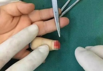 断指再植9.jpg 断指再植9.jpg