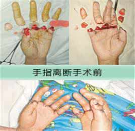 断指分类.jpg 断指分类.jpg
