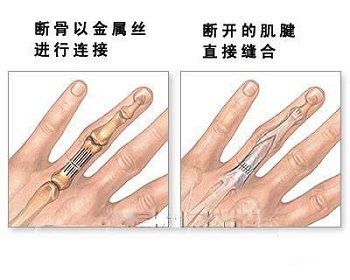 断指再植3.jpg 断指再植3.jpg