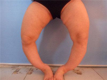 罗圈腿5.jpg 罗圈腿5.jpg