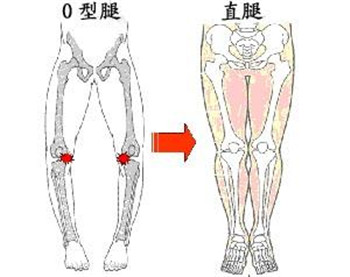 罗圈腿23.jpg 罗圈腿23.jpg