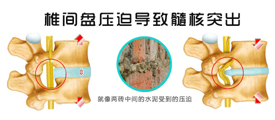 腰椎压迫神经.jpg 腰椎压迫神经.jpg