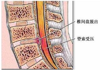 腰间盘突出滑脱怎么办.jpg 腰间盘突出滑脱怎么办.jpg