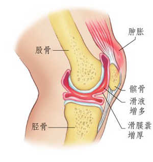 膝关节积液.jpg 膝关节积液.jpg